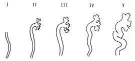  Figur 2    Det internasjonale graderinssystemet for vesikoureteral refluks (8)