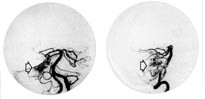  Figur 4    Cerebral angiografi hos pasient 2.  a) Frontserie som viser malformasjonen (&aring;pent pilhode), denne forsynes fra&hellip;