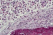  Figur 1a)    Beinmargsbiopsi ved diagnose av pasient 1. Merk spolformede celler paratrabekul&aelig;rt, enkelte med basofile&hellip;