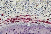  1b)    Beinmargsbiopsi ved diagnose av pasient 1. Binding av et monoklonalt antistoff (MCT-MAA1) spesifikk for tryptase i&hellip;