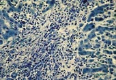  1c)    Leverbiopsi fra seksjon av pasient 1. Portalfelt med infiltrasjon av atypiske (spolformede) mastceller, hvorav noen&hellip;