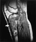 Figur 6    13 &aring;r gammel gutt. Sagittalt T1-vektet opptak viser utbredte osteomyelittforandringer i proksimale venstre tibia &hellip;