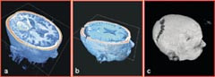 Figur 3    Bildebehandling av MR-data.  a) Fargekodet cerebral tumor (gr&oslash;nn ring) f&oslash;r &aring;pen operasjon i intervensjonsmagnet&hellip;