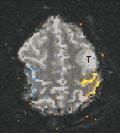 Figur 5    Funksjonell MR (fMRI) av hjernen. Preoperativ utredning av pasient med tumor (T) frontalt venstre side. Tromming&hellip;