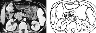  Figur 3    a) CT av pancreas annulare. Duodenum er helt omgitt av pancreasvev.  b) Skisse av CT-bildet. Pancreashodet som&hellip;