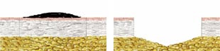  Figur 9 a, b    Incision av hud och subcutis med markerad hudtum&ouml;r i epidermis. Markeringen visar hur incisionen b&ouml;r ske&hellip;