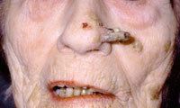 Figur 11  Cornu cutaneum (hudhorn)