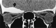 Figur 2  Spiral-CT-bilde rekonstruert fra 3D-opptak viser osteom med beinfortykkelse i orbitataket h&oslash;yre side (pil)