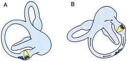 Figur&thinsp;&thinsp;3  Canalolithiasis: Teori som forklarer symptomer og funn ved benign paroksysmal posisjonsvertigo. a) Det affiserte&hellip;