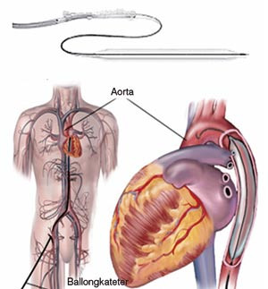 Figur 1  Intraaortal ballongpumpe med ballongkateter. Skjematisk fremstilling av ballongkateterets plassering med spissen&hellip;