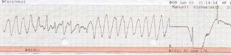 Figur 2 Hos pasient 2 viste utskrift fra defibrillator polymorf ventrikkeltakykardi