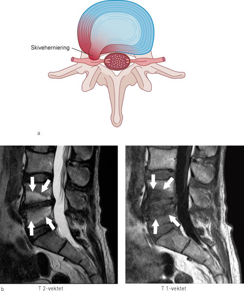 Figur 1 a) Skiveherniering. N&aring;r skiven hernierer, frisettes en rekke proinflammatoriske stoffer som p&aring;virker de&hellip;