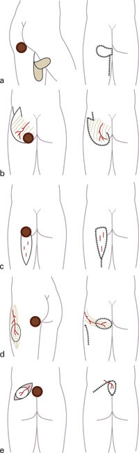 Figur 2  Forskjellige kirurgiske prosedyrer som brukes ved dekning av vevsdefekt etter eksisjon (og eventuell osteotomi) av&hellip;
