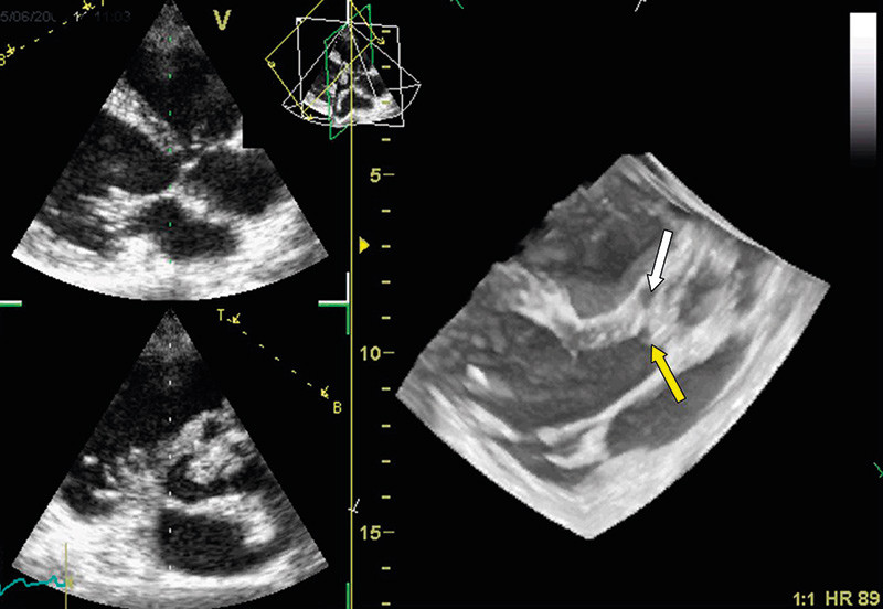 Figur 3  Transtorakalt opptak hos pasient med aortaklaffendokarditt. Gul pil markerer vegetasjon og hvit pil abscesshule&hellip;