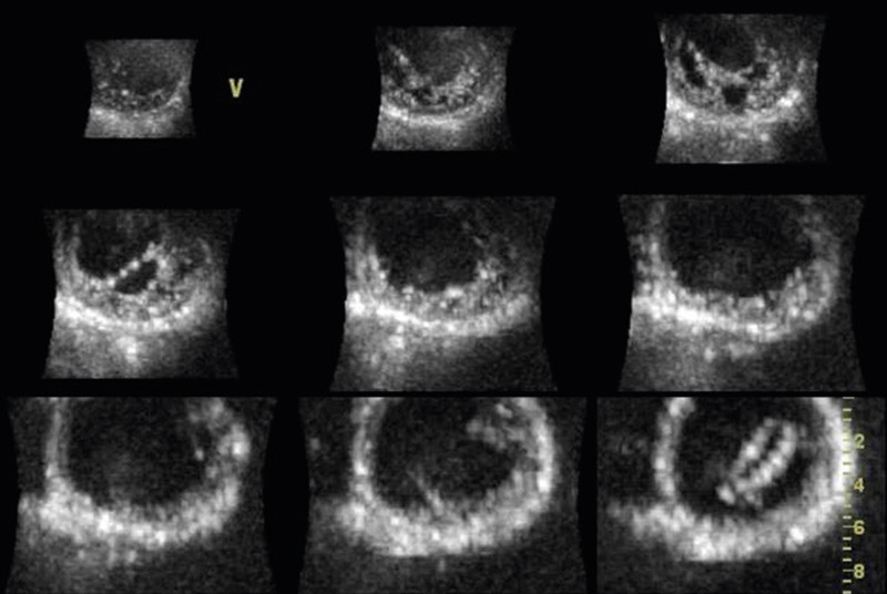 Figur 5  Kortaksesnitt av venstre hjertekammer hos pasient med manglende modning av myokard (non-compaction cardiomyopathy)&hellip;