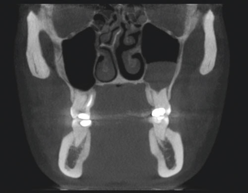 Figur 3  Koronale CBCT-skiver av skallen med v&aelig;ske i sinus maxillaris