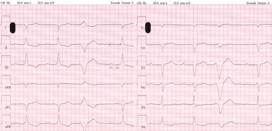 Figur 1  EKG (50 mm/s) registrert ved innleggelsen viste sinusrytme, AV-blokk grad 1 med PQ-tid 250 ms, suspekt gjennomg&aring;tt&hellip;