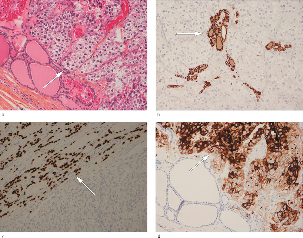 Figur 1  Metastase fra nyrecellekarsinom avgrenset mot normale thyreoideafollikler. a) Hematoksylin-eosin-safran-farget&hellip;