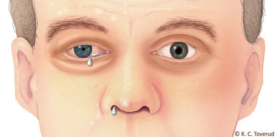 Figur 1  Kraniale autonome tegn under et klasehodepineanfall. Partielt Horners syndrom (ptose, miose), konjunktival&hellip;