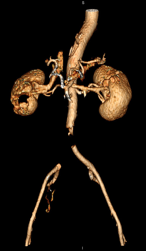 Figur 1  Tredimensjonal CT-angiografi viser manglende kontrastfylling i distale abdominalaorta og h&oslash;yre a. iliaca communis,&hellip;