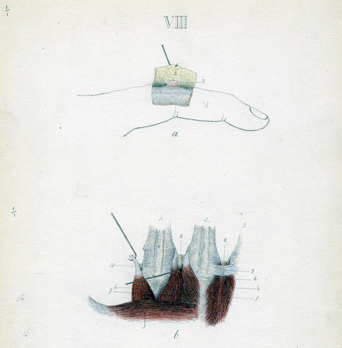 Finger og h&aring;nd. a) viser litt av pekefingerens dorsalaponevrose. b) synes &aring; vise volarsidens vaginae synoviales med&hellip;