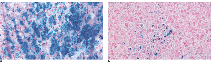 Figur 2  Leverbiopsi fra en mann i 50-&aring;rene med arvelig HFE-hemokromatose homozygot for C282Y-mutasjonen, a) f&oslash;r og b) etter&hellip;