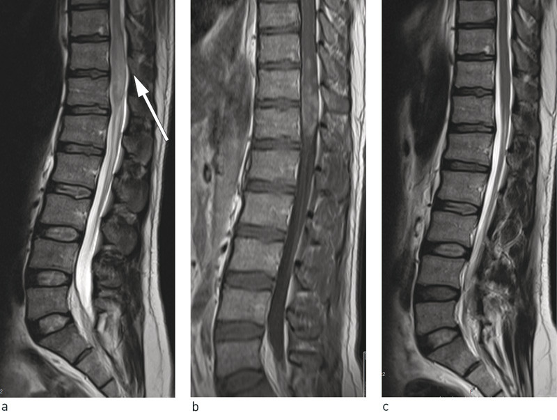 Figur 1  MR-unders&oslash;kelse av lumbosakralcolumna viser oppdriving av conus medullaris i niv&aring; Th 11/ Th 12 med h&oslash;ysignal p&aring; T2&hellip;