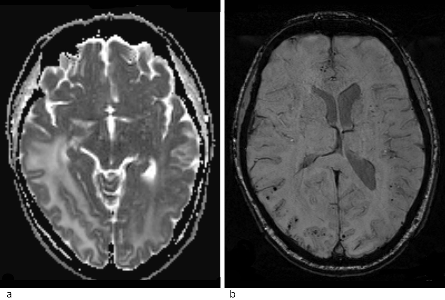 Figur 2 MR caput. a) ADC-kart fra diffusjon viser h&oslash;ye verdier forenlig med vasogent &oslash;dem. b) Suceptibilitetsvektede&hellip;