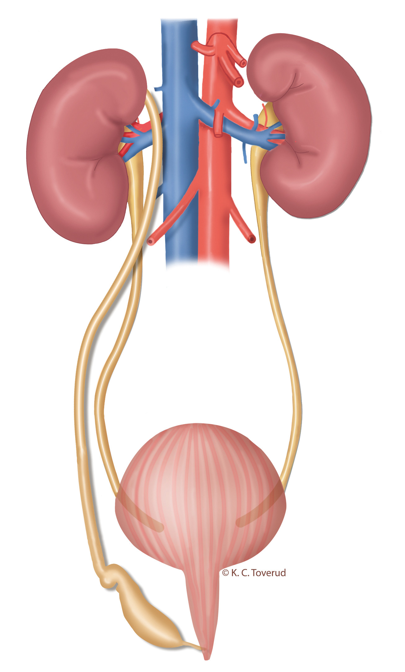 Figur 3 Modellen illustrerer dobbeltanlegg p&aring; h&oslash;yre side. Ureter fra det &oslash;vre anlegget er dilatert, men smalner av f&oslash;r det&hellip;