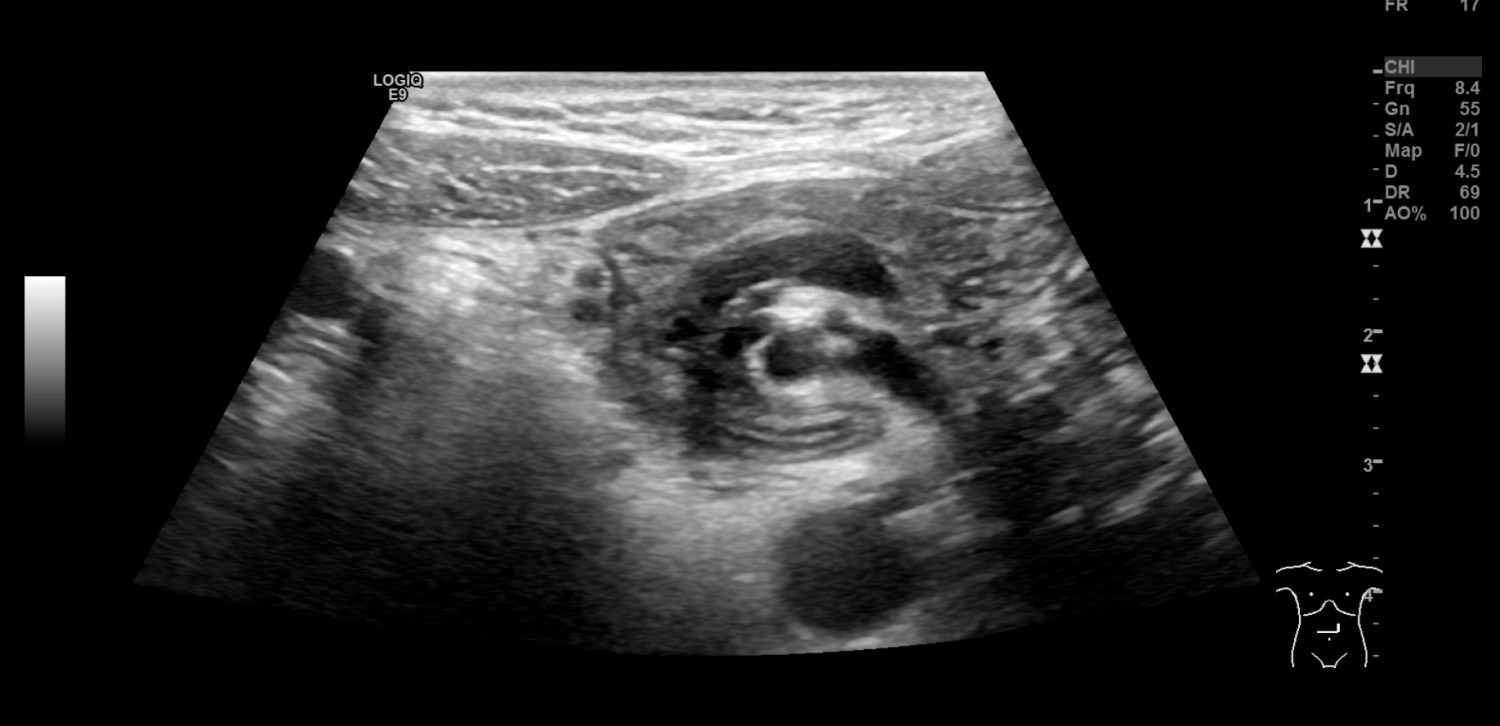 Figur 1 Ultralyd. Virvellignende rotasjon (&laquo;whirl sign&raquo;) som involverer kar og tynntarm i epigastriet.
