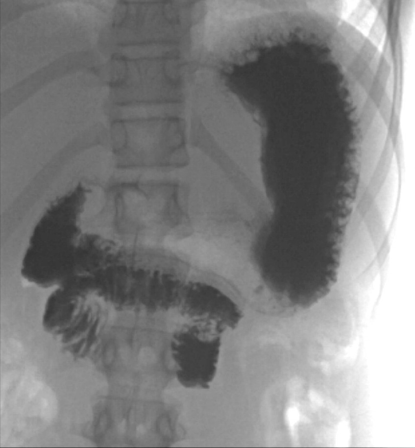Figur 3 R&oslash;ntgen &oslash;sofagus, ventrikkel og duodenum. Det er kontrast i ventrikkelen og spredt i duodenum som f&oslash;lger et typisk &hellip;