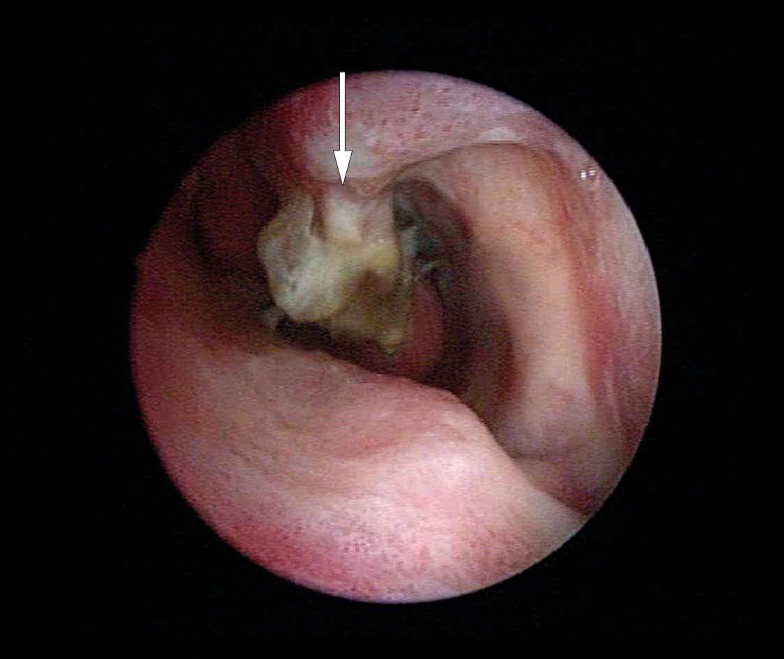 Figur 1 Pasient 1 ved tidspunkt for diagnose av osteomyelitt. Bildet viser en pussdekt og nekrotisk concha nasalis inferior &hellip;