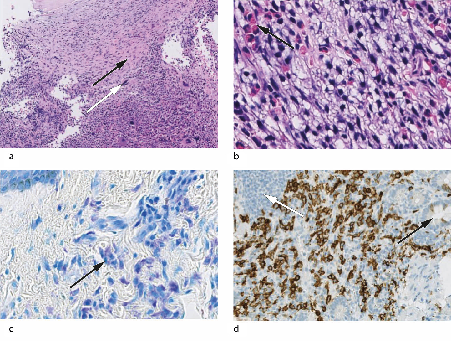 Figur 2 a) Beinmargsbiopsi. Margen er maksimalt cellerik. I &oslash;vre halvdel ses mastcelleinfiltrat assosiert med fibrose (svart&hellip;
