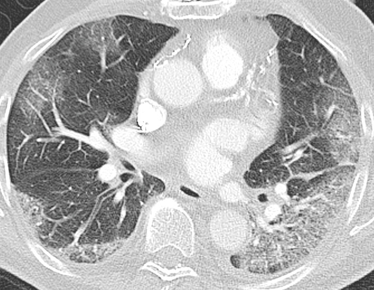 Figur 1 Pulmonal CT-angiografi tatt sykdomsdag 5. Aksialt CT-bilde med lungevindu viser l&oslash;st mettede mattglassfortetninger i&hellip;