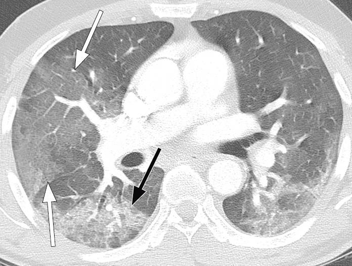 Figure 5 Patient with COVID-19. Chest CT seven days after symptom onset shows extensive bilateral ground-glass opacities &hellip;