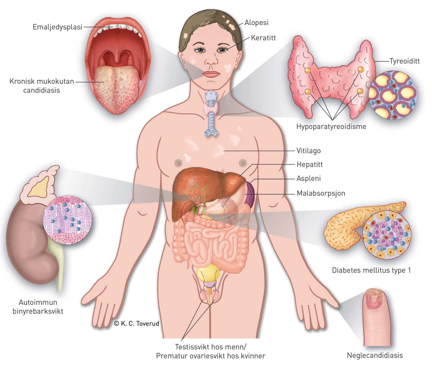Figur 1 Kliniske manifestasjoner som kan forekomme ved autoimmunt polyendokrint syndrom type 1 (APS-1). Figuren er gjengitt&hellip;