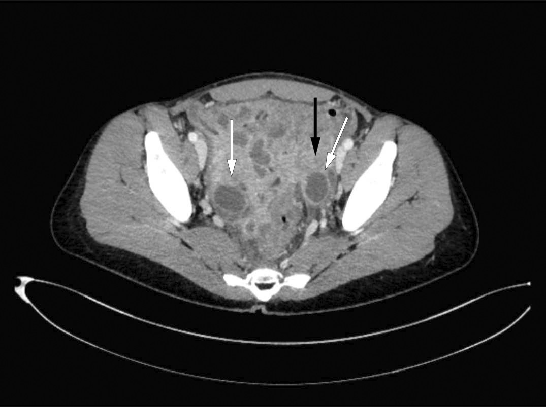 Figur 1 CT viste uttalt inflammasjon i bekkenet med forst&oslash;rrede, v&aelig;skefylte ovarier (hvite piler) samt veggfortykket colon&hellip;