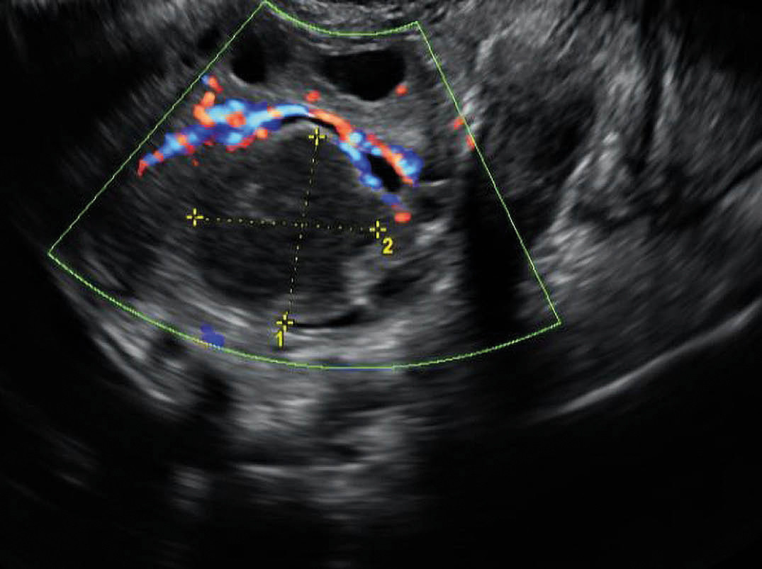 Figur 2 Vaginal ultralyd viste ovarium med lokulament p&aring; 2,5 &times; 2,4 cm, med middels ekkogivende innhold.