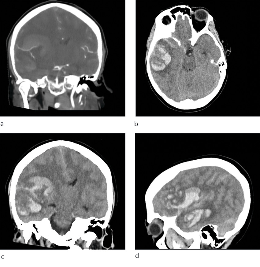Figur 1 CT caput p&aring; lokalsykehus viser stor parenkymbl&oslash;dning i h&oslash;yre hemisf&aelig;re med gjennombrudd til subaraknoidalrommet, b)&hellip;