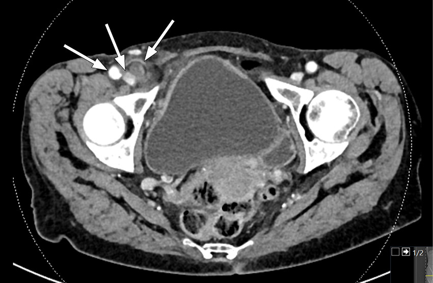 Figur 1 Aksialt CT-bilde som overfladisk i h&oslash;yre fossa viser en tubul&aelig;r struktur med tydelig omkringliggende&hellip;
