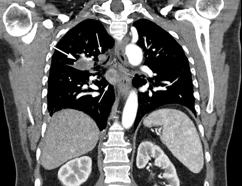 Figur 1 Koronal CT toraks med kontrast av pasient med pulmonal tularemi viser sentralt henfall b&aring;de i utbredt lymfadenopati &hellip;