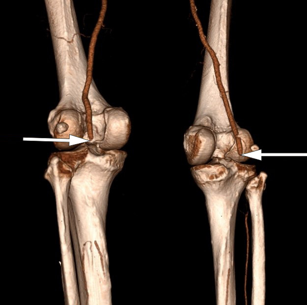 Figur 1 CT-angiografi viser bilateral full stopp i arteriell sirkulasjon i a. poplitea.