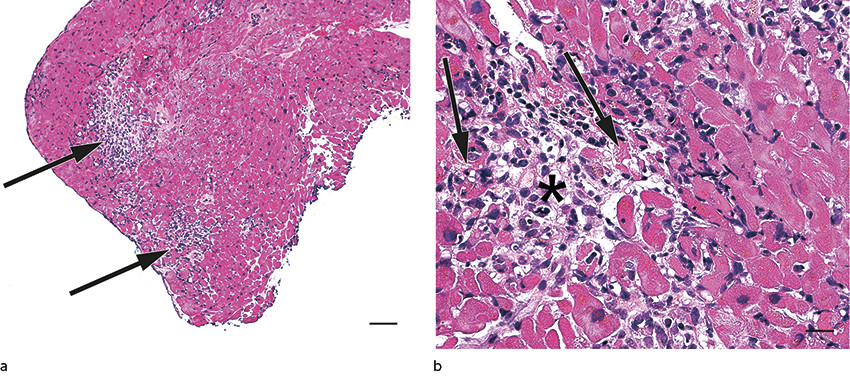 Figure 2 Haematoxylin-eosin- and saffron-stained myocardial biopsy section. a) Patchy inflammation infiltrates (arrows) are&hellip;