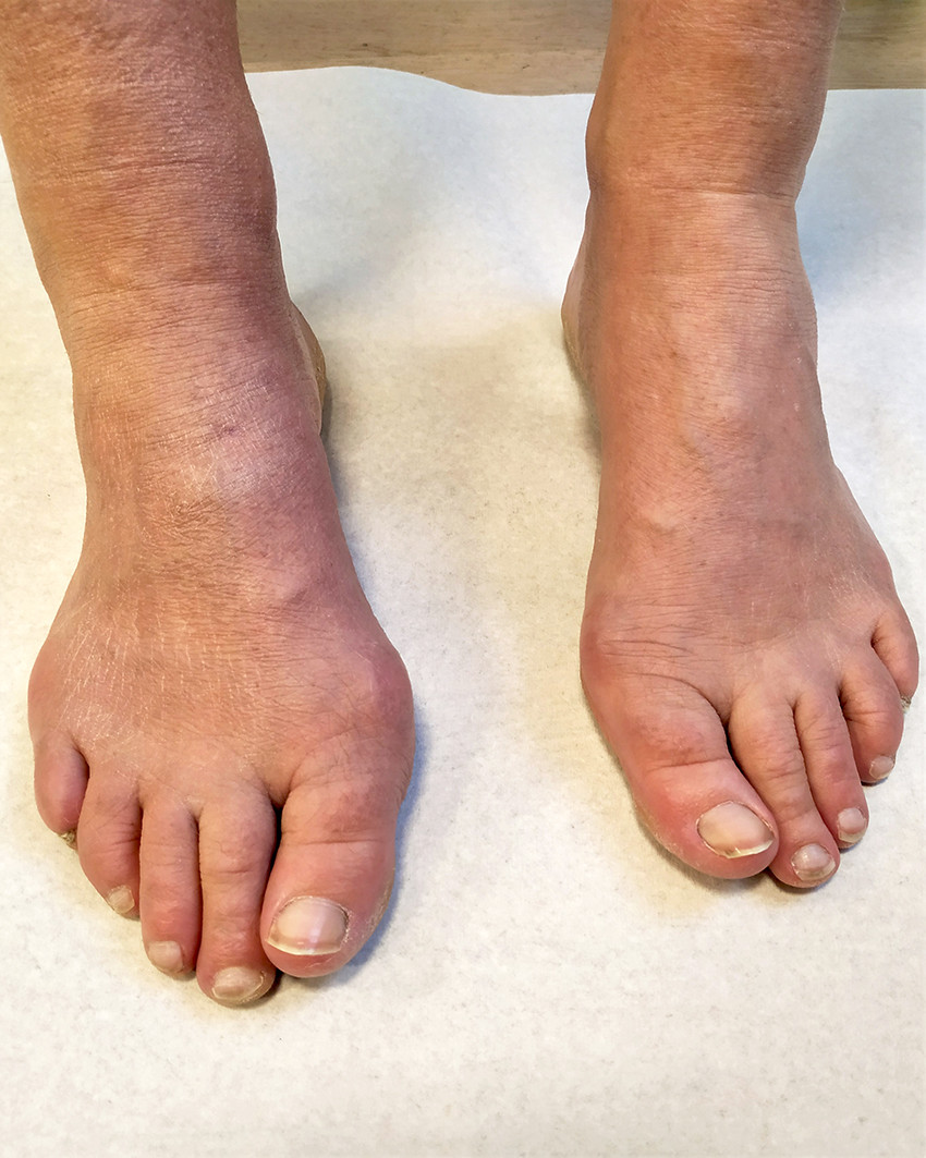Figur 1 Acrodermatitis chronica atrophicans p&aring; h&oslash;yre fotrygg. Det er tydelig st&oslash;rrelsesforskjell rundt ankel og forfot&hellip;