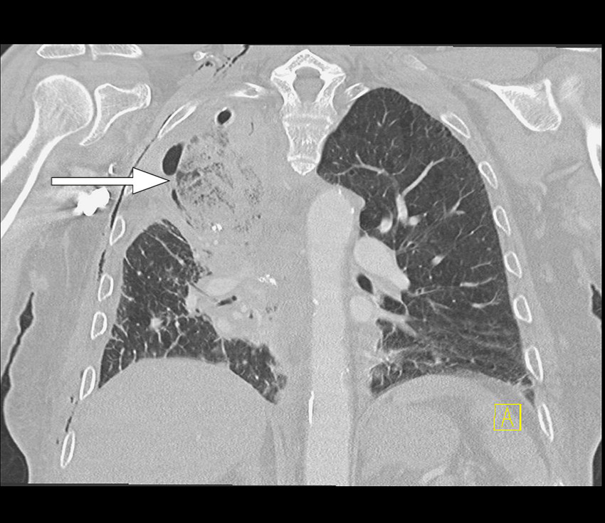 Figur 2 CT toraks med intraven&oslash;st kontrastmiddel tatt f&oslash;rste postoperative dag etter prim&aelig;roperasjonen. Koronalt snitt med&hellip;