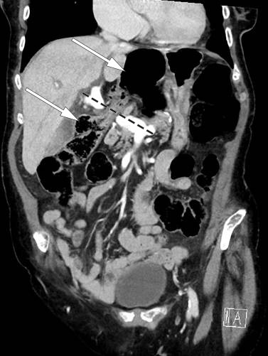 Figur 1 CT av buken, aksialplan. Pilene peker p&aring; c&oslash;kum som er herniert gjennom Winslows foramen og ligger som en luftfylt&hellip;