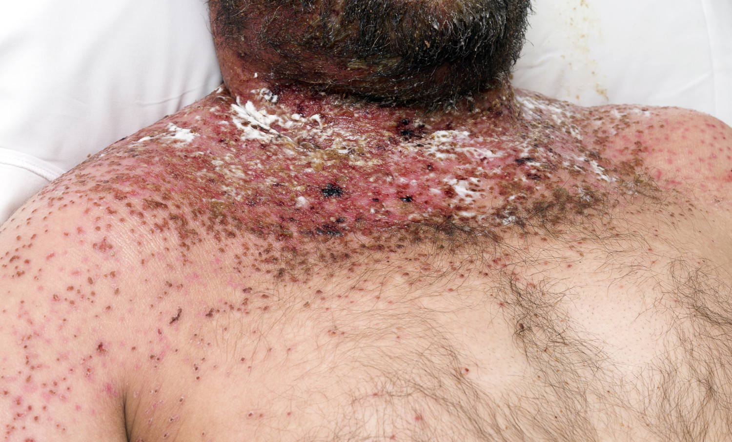 Figure 1 Extensive erosions and weeping eczema on the face, neck and throat, with scattered crusted erosions on the neck,&hellip;