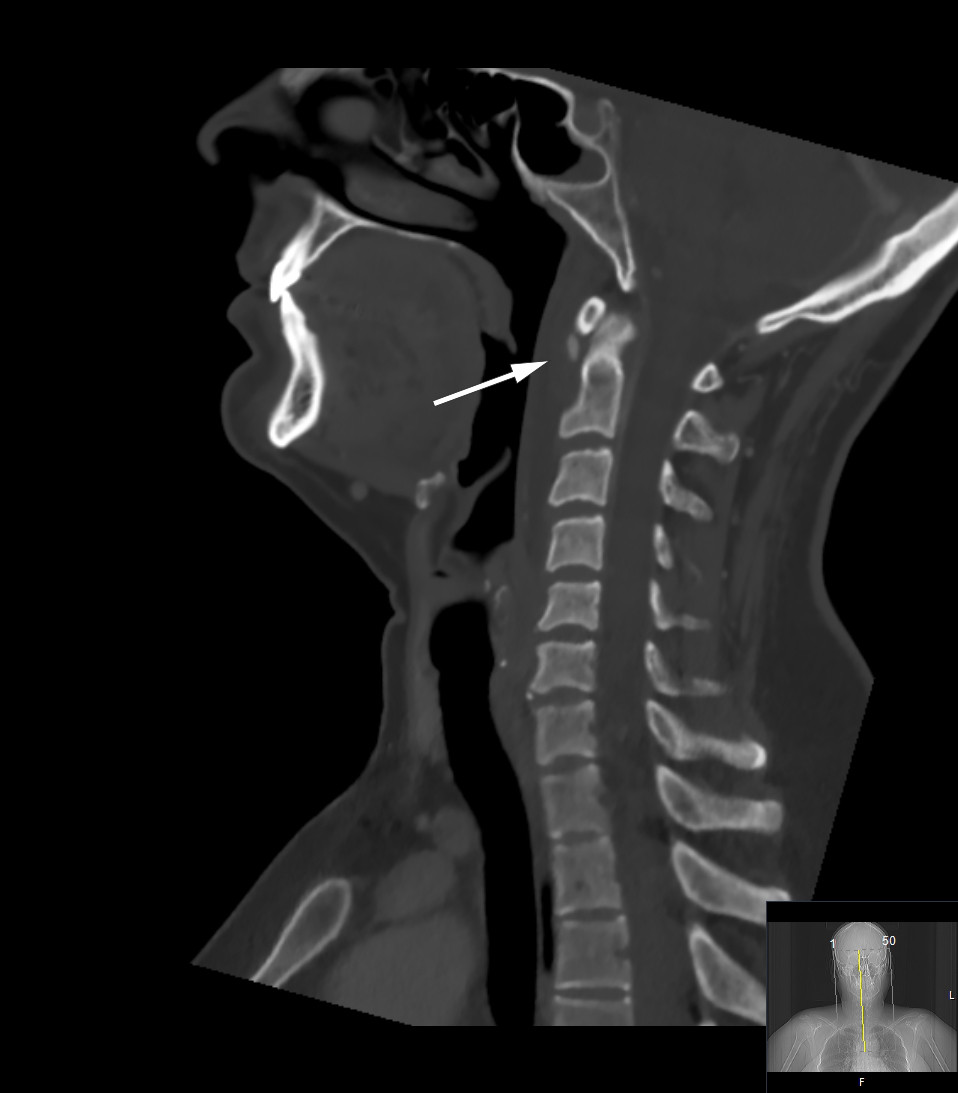 Figur 1 CT collum (benvindu) med typisk funn ved kalsifiserende tendinitt i m. longus colli: avrundet forkalkning nedenfor&hellip;