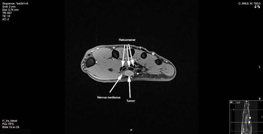 Figur 3 MR av h&aring;nd, T1-vektet, transversalplan, fettsupprimert. Merk tumors n&aelig;re relasjon til medianusnerven og fleksorsener&hellip;