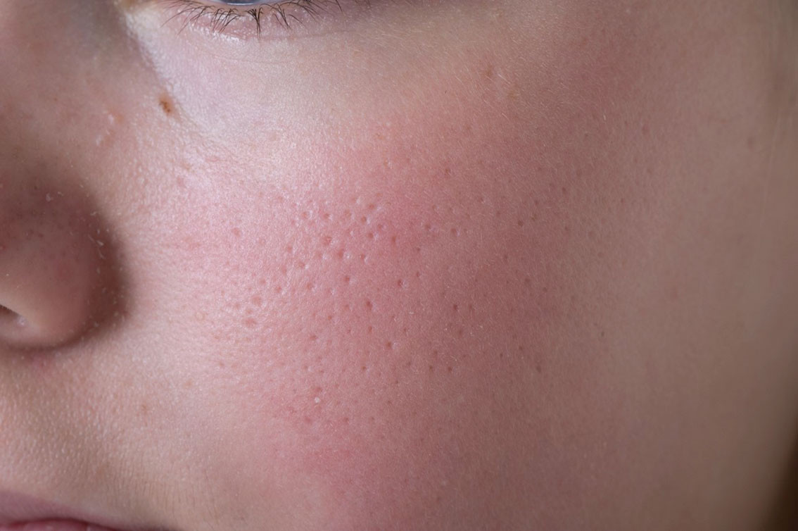 Figur 3 Keratosis pilaris atrophicans (atrophoderma vermiculatum) i ansiktet.